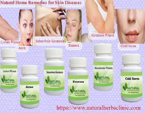 Skin diseases are very general and affect as numerous as one in 3 Americans at any specified time. Common skin diseases include acne, Cold Sores, Lichen Planus, Seborrheic Keratosis, Eczema, Psoriasis, and Keratosis Pilaris... https://www.naturalherbsclinic.com/blog/the-most-common-skin-disease-and-their-treatment-planning/