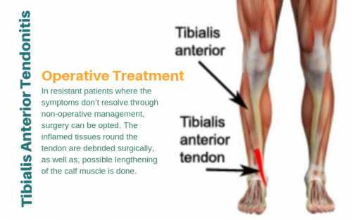 Tibialis-anterior-tendonitis.png