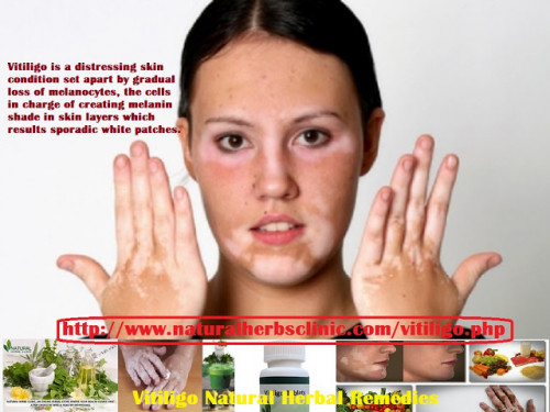 Vitiligo-Herbal-Remedies.jpg