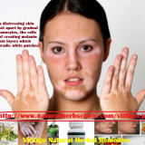 Vitiligo-Herbal-Remedies