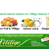 Vitiligo-Natural