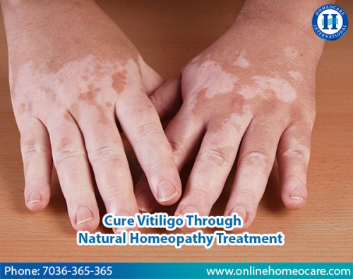 Vitiligo-With-Homeopathic-Treatment.jpg