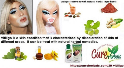 Cure Herbals offers herbal natural oil for the Vitiligo Natural treatment. This oil is purely made with herbal ingredients which work properly without any side effects... http://www.guide.ind.in/for-sale/business-industry/vitiligo-natural-226002.htm