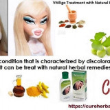 Vitiligo-and-Natural-Treatment