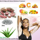 Vitiligo-and-its-Natural-Healing-Procedure