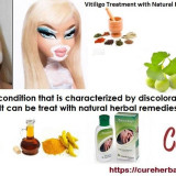 Vitiligo-and-its-Natural-Herbal-Treatment