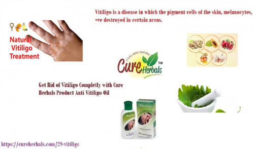 The only treatment that can easily be available and these are the only therapies that are 100% reliable. These are the Natural treatments and therapies. Vitiligo Natural Treatments are the 100% reliable treatments and these treatments cause no harm so anti vitiligo oil is the product that is used to fight with vitiligo by herbal method... https://curewithherbals.yolasite.com/vitiligo-natural.php