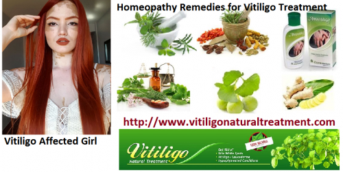 Vitiligo-and-its-Natural-Treatment-with-Homeopathy-Method.png