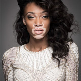 Vitiligo-and-its-natural-Treatment