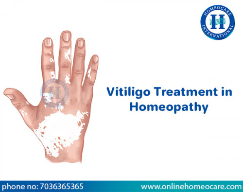 Vitiligo-treatment-in-homeopathy.jpg