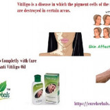 Vitiligo