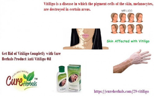 Vitligo-White-Spots-on-Skin-and-Its-Treatment-Naturally.jpg