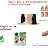 Vitligo-White-Spots-on-Skin-and-Its-Treatment-Naturally