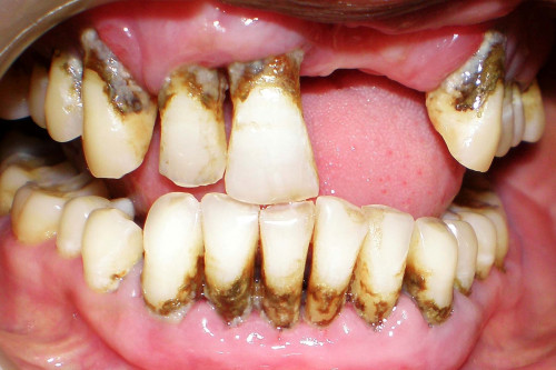 What-Does-Gum-Disease-Look-Like.jpg