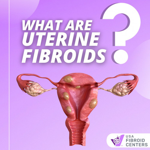 What-are-Uterine-Fibroids.jpg
