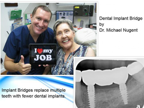 dental-implant-bridge.jpg