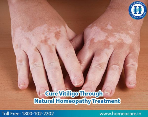 Loss of skin color due to the improper production of melanin or death of melanin cells leads to vitiligo. It may affect any part of the body usually it starts with skin may also occur inside the mouth and on hair. White patchy skin, premature whitening of skin and hair, loss of skin color. Causes include family history, smoking, chemical exposure. Homeocare international provides effective treatment in stopping the progression of the disease by increasing melanin content and treatment differs for individuals depending on their symptoms and progression rate the prime goal of treatment is to stop or slow the rate of disease progression.

toll free no:18001022202.

for more details please visit to : https://www.homeocare.in/homeopathy-vitiligo-treatment.html