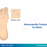 homeopathy-treatment-for-warts