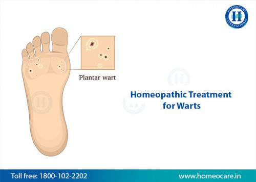 homeopathy treatment for warts