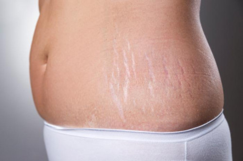 stretch-marks-removal.jpg